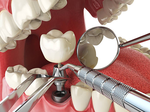 Best Emergency Wisdom Tooth Extraction in Syracuse, NE